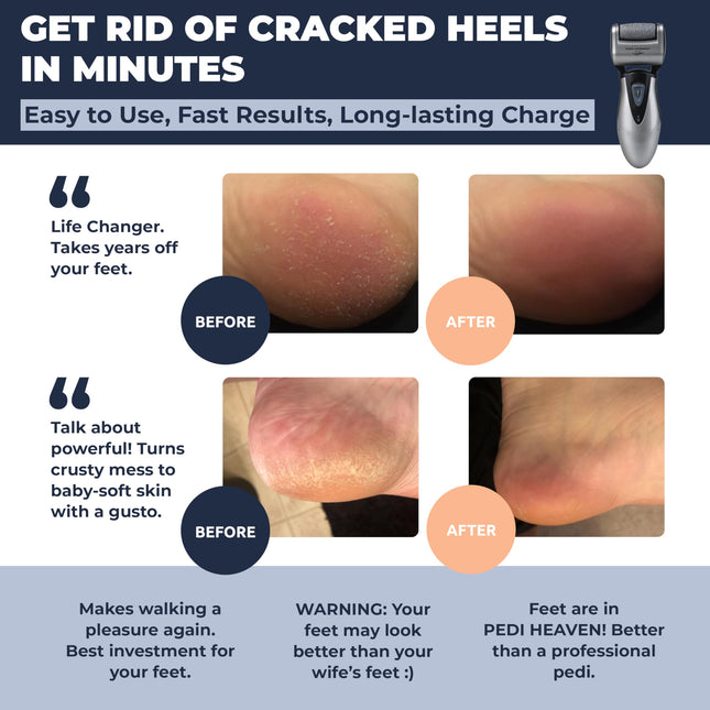 Own Harmony Electric Pedicure Callus Remover – 3 Rollers
